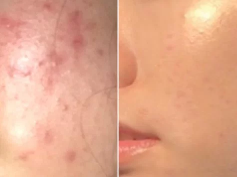 Pimple, Acne Skincare Routine In Summer Treatment