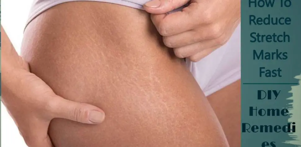 how to get rid of stretching marks, how to get rid or stretch marks, how to get rid stretch mark, get ride of stretch marks, how to get rid of stretch marks faster, how do you get rid of stretch marks, how to get rid of stretch marks on buttocks, best way to get rid of stretch marks, how to get rid of stretch marks in arms, how to get rid of stretch marks natural, how to get rid of stretch marks fast naturally, remove stretchmarks, stretch mark how to remove, fastest way to get rid of stretch marks, how to remove stretch marks on thighs, stretch mark removal naturally, stretch marks remove, home remedy for stretch mark removal, how to take off stretch marks fast, stretch mark remedies at home, getting rid of stretch marks naturally, what can i use to get rid of stretch marks, stretch marks home remedy, stretch mark natural treatment, best home remedy for stretch marks, how to get rid of red lines on stomach, best way to rid of stretch marks, how to get rid of stomach lines,